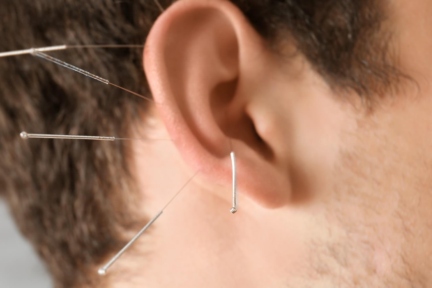 técnica auriculopuntura centro mushu